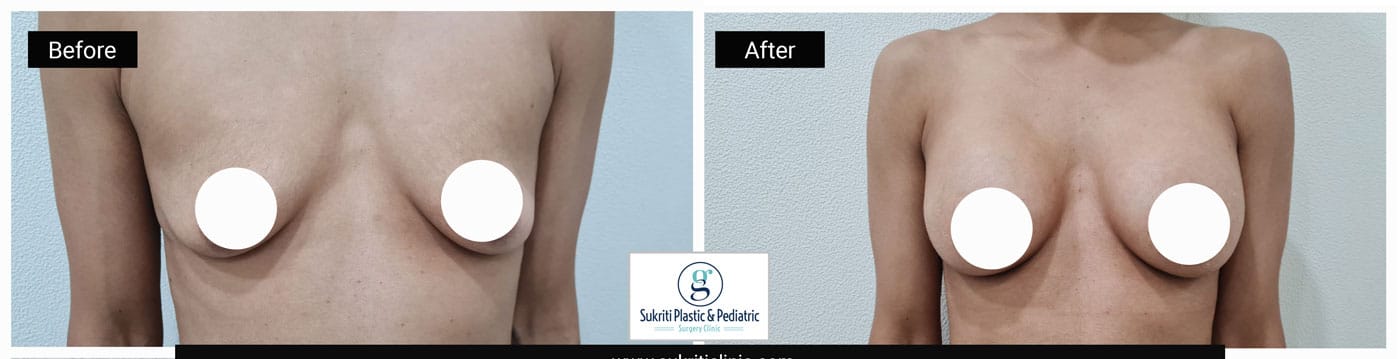 Breast-Augmentation-1