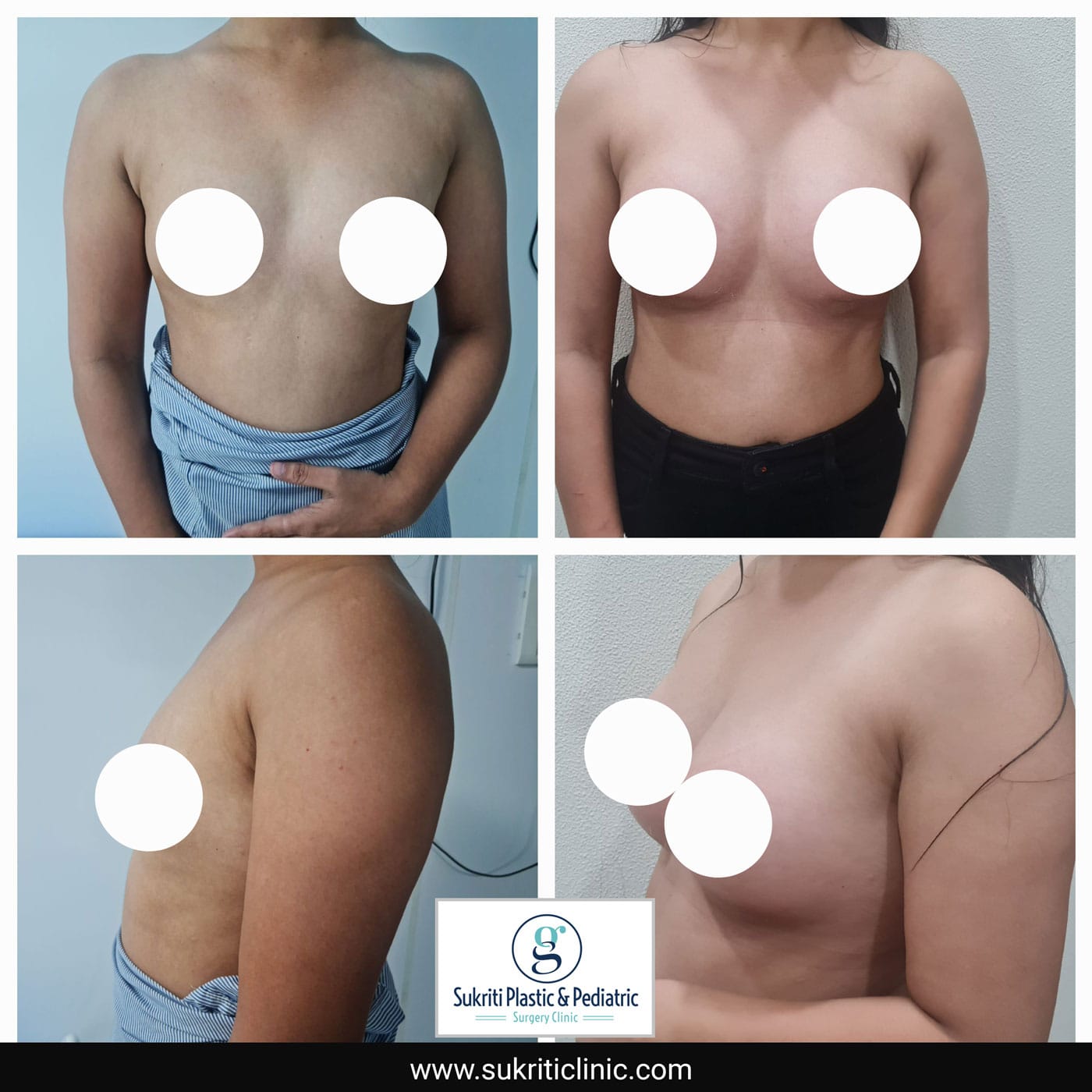 Breast-Augmentation