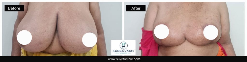 Breast reduction surgery Breast-reduction