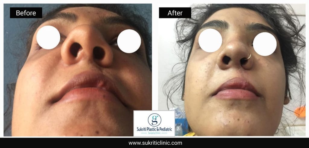 Pediatric Plastic surgery Cleft Rhinoplasty