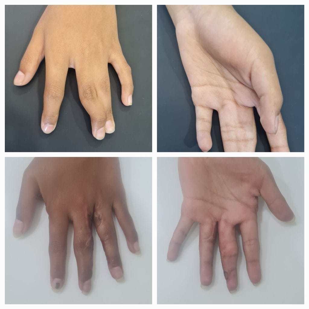 Pediatric Plastic surgery Syndactyly correction