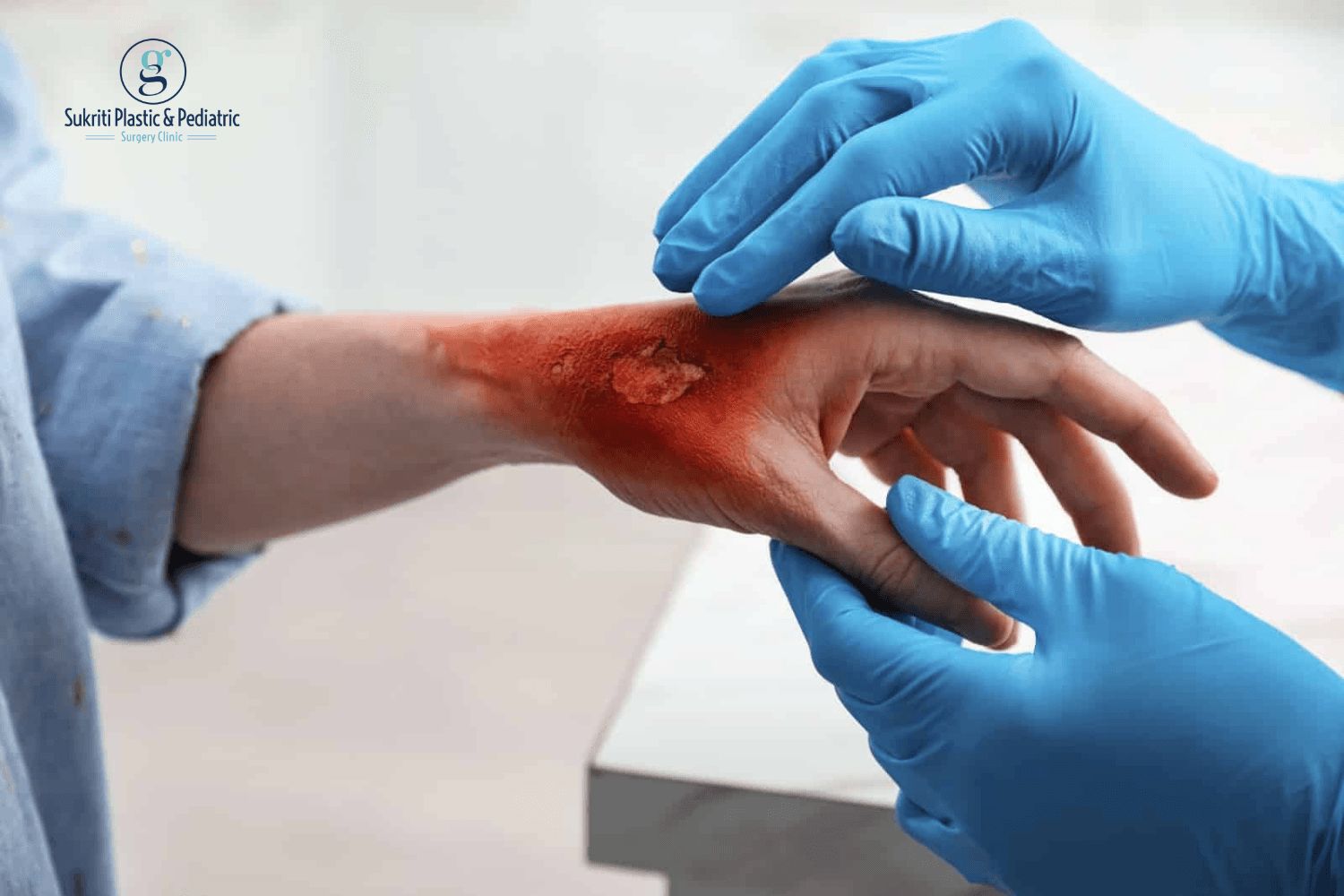 Emotional Recovery After Burns: Healing Beyond the Scars - Sukriti ...