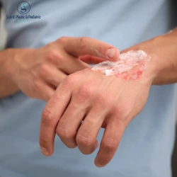 Best Treatment for Burn Deformities in Indore, burn deformity correction, reconstructive burn surgery, skin grafting procedures, laser scar treatment, burn deformity treatment in indore, burn scar correction indore, reconstructive plastic surgery indore, skin graft surgery indore hospitals, laser scar removal indore clinics, contracture release surgery indore, burn rehabilitation centres indore, advanced burn care indore, post burn scar treatment indore, cosmetic burn surgery indore, burn physiotherapy indore, scar revision surgery indore, burn specialist consultation indore, plastic surgeon for burns indore, burn wound care indore, burn contracture therapy indore, best hospitals for burn deformities indore, burn reconstruction experts indore, scar management treatment indore, burn recovery clinics indore, burn treatment specialists madhya pradesh, post burn rehabilitation indore, burn deformity correction india, burn surgery options indore, burn scar laser therapy indore, burn care support indore, advanced reconstructive techniques indore, functional burn correction indore, burn survivor treatment indore, comprehensive burn care indore