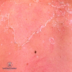 First Aid for Burns, burn injury treatment, burn care at home, burn specialist in indore, minor burn first aid, burn treatment indore, burn doctor indore, burn care clinic indore, plastic surgeon indore burns, emergency burn care indore, skin grafting indore, burn wound dressing indore, burn scar treatment indore, burn hospital indore, best burn specialist indore, burn injury help indore, thermal burn treatment indore, chemical burn doctor indore, electrical burn treatment indore, burn first aid indore, burn recovery clinic indore, skin healing treatment indore, burn pain relief indore, burn infection treatment indore, cosmetic burn repair indore, advanced burn care indore, burn rehabilitation indore, pediatric burn care indore, burn consultation indore, burn scar removal indore, wound care specialist indore, skin trauma doctor indore, burn emergency services indore, burn treatment near me indore, plastic surgery burns indore