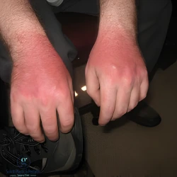 Burn Surgery, Degrees of Burn Injury, Burn Treatment in Indore, Burn Reconstruction Surgery, Burn Specialist in Indore, burn treatment in indore, burn specialist indore, skin burn treatment indore, cosmetic burn repair indore, burn injury treatment indore, burn surgeon in indore, best cosmetologist in indore, burn scar treatment indore, plastic surgery for burns indore, burn wound care indore, burn reconstruction indore, skin graft surgery indore, cosmetic skin repair indore, advanced burn care indore, skin healing treatment indore, burn injury doctor indore, burn scar correction indore, skin restoration treatment indore, cosmetic burn surgery indore, skin graft specialist indore, burn recovery treatment indore, burn wound specialist indore, skin injury treatment indore, burn damage repair indore, cosmetic skin surgery indore, advanced skin care indore, skin repair clinic indore, burn scar management indore, cosmetic skin treatment indore, professional burn care indore