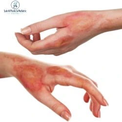 Burn Injury Treatment in Indore: First Aid, Surgery & Recovery Burn Injury Treatment in Indore, Burn Injury Surgery, Burn Scar Treatment, Cosmetologist in Indore, Burn Recovery Treatment, burn treatment in indore, burn injury doctor indore, skin burn treatment indore, burn scar removal indore, cosmetologist near me, cosmetic clinic indore, burn care specialist indore, laser treatment for burn scars indore, plastic and cosmetic treatment indore, skin specialist indore, scar reduction treatment indore, facial burn treatment indore, hand burn treatment indore, chemical burn treatment indore, hot water burn treatment indore, burn wound care indore, cosmetic surgery for burns indore, advanced burn treatment indore, burn skin grafting indore, skin healing treatment indore, aesthetic clinic indore, burn injury recovery indore, scar correction indore, skin reconstruction treatment indore, cosmetic procedures indore, post burn scar treatment indore, skin repair treatment indore, best cosmetologist indore, cosmetic surgeon indore, burn first aid treatment