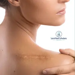 Burn Scar Removal Treatment in Indore Burn Scar Removal Treatment in Indore, Burn Scar Treatment, Scar Revision Surgery, Laser Treatment for Burn Scars, cosmetic Surgeon in Indore, burn scar treatment in indore, burn scar removal in indore, cosmetic surgeon in indore, burn injury treatment indore, scar removal doctor in indore, laser scar treatment indore, burn scar specialist indore, skin grafting treatment indore, hypertrophic scar treatment indore, keloid scar treatment indore, burn care specialist indore, cosmetic burn treatment indore, scar revision surgery indore, cosmetic scar treatment indore, advanced scar treatment indore, skin resurfacing for scars indore, contracture scar treatment indore, burn scar laser therapy indore, child burn treatment indore, best cosmetic surgeon indore, burn wound care indore, plastic and reconstructive scar treatment indore, burn scar management indore, skin healing treatment indore, burn injury recovery indore, scar therapy indore, laser skin treatment indore, burn surgery specialist indore, cosmetic burn care indore, burn scar clinic indore