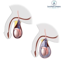 Difference Between Hernia and Hydrocele in Children Difference Between Hernia and Hydrocele in Children, Pediatric Hernia Treatment, Hydrocele in Children, Pediatric Surgeon in Indore, Child Hernia Surgery, hernia treatment in indore, hydrocele treatment in indore, pediatric surgeon in indore, child hernia doctor indore, pediatric hydrocele treatment indore, inguinal hernia treatment indore, child swelling near groin indore, pediatric urology indore, hydrocele surgery indore, child surgery specialist indore, newborn hernia treatment indore, baby hydrocele doctor indore, pediatric laparoscopic surgery indore, groin swelling child indore, pediatric surgical care indore, child abdominal swelling treatment indore, pediatric clinic indore, pediatric surgical consultation indore, child hydrocele specialist indore, hernia specialist indore, pediatric minimally invasive surgery indore, infant hernia treatment indore, child scrotal swelling indore, baby groin lump treatment indore, pediatric operation indore, hydrocele specialist indore, child health specialist indore, pediatric healthcare indore, pediatric surgeon near me indore, best pediatric surgeon indore