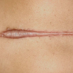 Scar Revision Surgery in Indore Scar Revision Surgery in Indore, Dr. Geetika Paliwal, Cosmetologist in Indore, Acne Scar Treatment in Indore, Burn Scar Removal Treatment, scar revision surgery in indore, scar treatment in indore, cosmetologist in indore, best scar doctor in indore, acne scar treatment indore, burn scar treatment indore, surgical scar removal indore, keloid scar treatment indore, skin specialist in indore, cosmetic skin treatment indore, laser scar removal indore, skin clinic in indore, acne marks treatment indore, scar removal doctor indore, hypertrophic scar treatment indore, facial scar treatment indore, advanced scar treatment indore, scar correction surgery indore, skin resurfacing indore, laser skin clinic indore, microneedling treatment indore, cosmetic surgeon indore, skin texture treatment indore, scar revision clinic indore, best cosmetologist indore, pigmentation and scar treatment indore, aesthetic clinic indore, skin laser treatment indore, injury scar treatment indore, scar management treatment indore