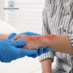 Best Doctor for Burn Treatment in Indore: When to See a Plastic Surgeon in Indore Best Doctor for Burn Treatment in Indore, Dr. Saurabh Garge, Pediatric Surgeon in Indore, Burn Treatment in Indore, Plastic Surgeon for Burns, burn specialist in indore, plastic surgeon indore, burn treatment doctor indore, skin burn treatment indore, pediatric burn surgeon indore, child burn treatment indore, burn injury care indore, emergency burn treatment indore, plastic surgery for burns indore, burn scar treatment indore, burn wound specialist indore, thermal burn treatment indore, chemical burn treatment indore, best pediatric surgeon indore, pediatric surgery indore, wound care doctor indore, burn dressing treatment indore, advanced burn care indore, laser scar treatment indore, burn recovery treatment indore, hand burn treatment indore, facial burn treatment indore, cosmetic burn repair indore, surgery for burns indore, skin grafting indore, burn trauma care indore, child injury treatment indore, burn care hospital indore, burn reconstruction indore, scar revision surgery indore