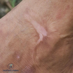 burn scar treatment in Indore, burn scar removal in Indore, cosmetologist in Indore, cosmetic surgeon in Indore, scar revision surgery in Indore, burn scar specialist in Indore, skin scar treatment Indore, plastic surgeon Indore, burn injury treatment Indore, scar reduction treatment Indore, laser scar treatment Indore, best cosmetologist in Indore, skin specialist Indore, burn scar correction Indore, hypertrophic scar treatment Indore, keloid scar treatment Indore, cosmetic clinic Indore, aesthetic treatment Indore, skin rejuvenation Indore, post burn scar treatment Indore, scar management Indore, advanced scar treatment Indore, burn wound care Indore, cosmetic surgery clinic Indore, scar improvement treatment Indore, skin repair treatment Indore, burn marks treatment Indore, aesthetic surgeon Indore, skin care clinic Indore, Dr Geetika Paliwal Indore