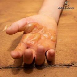 Home Remedies for Burns, Burn Treatment at Home, Burn Scar Treatment, Cosmetologist in Indore, First Aid for Burns, burn treatment in indore, cosmetologist in indore, burn scar treatment indore, skin specialist indore, burn doctor in indore, cosmetic treatment indore, plastic surgeon indore, burn injury treatment indore, scar removal treatment indore, laser scar treatment indore, skin clinic in indore, first aid for burns indore, burn care specialist indore, best cosmetologist in indore, skin care doctor indore, burn marks treatment indore, burn wound treatment indore, cosmetic clinic indore, burn healing treatment indore, skin scar treatment indore, advanced scar treatment indore, burn surgery indore, aesthetic clinic indore, skincare treatment indore, burn management indore, skin laser clinic indore, reconstructive treatment indore, facial scar treatment indore, cosmetic surgeon indore, dr. geetika paliwal indore