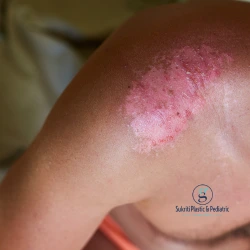 burn treatment in Indore, cosmetologist in Indore, plastic surgeon in Indore, burn specialist in Indore, skin burn treatment Indore, emergency burn care Indore, burn injury doctor Indore, cosmetic surgeon Indore, burn scar treatment Indore, burn wound care Indore, severe burn treatment Indore, pediatric burn treatment Indore, burn healing specialist Indore, burn reconstruction surgery Indore, burn management Indore, skin specialist for burns Indore, advanced burn care Indore, burn clinic Indore, burn scar removal Indore, cosmetic burn treatment Indore, burn infection treatment Indore, best burn doctor Indore, burn consultation Indore, skin repair after burns Indore, thermal burn treatment Indore, chemical burn treatment Indore, facial burn treatment Indore, hand burn treatment Indore, burn recovery specialist Indore, plastic surgery for burns Indore