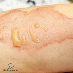 burn contracture treatment in Indore, burn contracture surgery in Indore, burn scar treatment in Indore, burn scar surgery in Indore, contracture release surgery in Indore, burn reconstruction surgery in Indore, plastic surgeon for burn scars in Indore, burn scar specialist in Indore, burn contracture specialist in Indore, scar revision surgery in Indore, burn injury treatment in Indore, post burn contracture treatment Indore, post burn scar surgery Indore, joint stiffness after burn treatment Indore, skin graft surgery for burns Indore, burn rehabilitation in Indore, scar reconstruction specialist Indore, burn scar plastic surgeon Indore, reconstructive surgeon in Indore, plastic surgery for burn contractures Indore, burn contracture treatment near me Indore, burn scar treatment near me Indore, best doctor for burn contracture in Indore, burn scar correction in Indore, burn surgery specialist Indore, hand burn contracture treatment Indore, neck burn contracture surgery Indore, elbow burn contracture treatment Indore, knee burn contracture surgery Indore, burn scar reconstruction surgery Indore