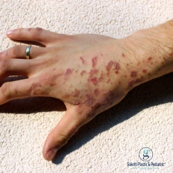Can Old Burn Scars Be Treated, old burn scar treatment, burn scar revision, laser treatment for burn scars, burn contracture surgery, plastic surgeon in Indore, Dr Geetika Paliwal Indore, burn scar specialist in Indore, old burn scar treatment Indore, burn scar removal in Indore, laser scar treatment Indore, scar revision surgery Indore, burn reconstruction surgery Indore, burn contracture treatment Indore, burn scar correction Indore, hypertrophic scar treatment Indore, keloid treatment in Indore, plastic surgery for burn scars Indore, reconstructive surgeon in Indore, burn surgeon in Indore, burn scar laser therapy Indore, old scar removal treatment Indore, skin graft surgery Indore, contracture release surgery Indore, facial burn scar treatment Indore, hand burn scar treatment Indore, neck burn contracture treatment Indore, raised burn scar treatment Indore, painful burn scar treatment Indore, itchy burn scar treatment Indore, burn deformity correction Indore, scar treatment clinic Indore, plastic surgeon near me Indore, burn scar doctor near me Indore, reconstructive plastic surgery Indore