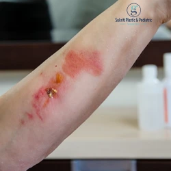 Electrical and Chemical Burns: Why They Need Different Surgical Care Electrical burn treatment in Indore, Chemical burn treatment in Indore, Burn injury treatment Indore, Plastic surgeon for burns Indore, Reconstructive surgeon in Indore, Burn wound care Indore, Electrical burn surgery Indore, Chemical burn surgery Indore, Skin grafting in Indore, Burn reconstruction surgery Indore, Burn scar treatment Indore, Burn contracture surgery Indore, Scar revision surgery Indore, Flap surgery in Indore, Deep burn treatment Indore, Severe burn treatment Indore, Electrical injury treatment Indore, Chemical injury treatment Indore, Hand burn treatment Indore, Facial burn treatment Indore, Industrial burn treatment Indore, Acid burn treatment Indore, Burn wound surgeon Indore, Skin grafting surgeon Indore, Burn scar plastic surgery Indore, Reconstructive plastic surgery Indore, Burn contracture treatment Indore, Plastic surgeon for burn scars Indore, Burn wound reconstruction Indore, Dr Geetika Paliwal Indore