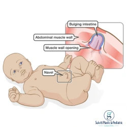 Inguinal Hernia in children Indore, pediatric Inguinal Hernia Indore, Inguinal Hernia treatment Indore, Inguinal Hernia surgery Indore, pediatric hernia surgeon Indore, child hernia specialist Indore, pediatric surgeon in Indore, Dr Saurabh Garge Indore, Dr Saurabh Garge pediatric surgeon, child Inguinal Hernia surgery Indore, groin swelling in children Indore, groin lump in child Indore, hernia in babies Indore, baby Inguinal Hernia Indore, infant hernia treatment Indore, hernia surgery for children Indore, pediatric laparoscopic hernia surgery Indore, laparoscopic hernia surgery child Indore, inguinal herniotomy Indore, pediatric herniotomy Indore, scrotal swelling in child Indore, groin swelling baby Indore, child hernia doctor Indore, best pediatric surgeon for hernia Indore, pediatric hernia treatment Indore, hernia specialist for children Indore, Inguinal Hernia in boys Indore, Inguinal Hernia in girls Indore, child groin hernia treatment Indore, pediatric surgery clinic Indore