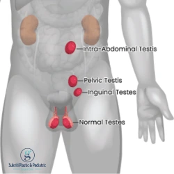 Undescended Testicle Surgery in Indore: Best Pediatric Urologist in Indore Undescended testicle treatment in Indore, undescended testicle surgery in Indore, pediatric surgeon in Indore, pediatric urologist in Indore, Dr. Saurabh Garge Indore, orchiopexy surgery in Indore, cryptorchidism treatment in Indore, undescended testes treatment, undescended testicle in children, orchiopexy for children, pediatric urology specialist Indore, best pediatric surgeon in Indore, child urologist in Indore, undescended testicle surgery for child, cryptorchidism surgery for children, orchiopexy procedure, treatment for undescended testis, undescended testis in newborn baby, surgery for undescended testicle, pediatric testicular surgery Indore, laparoscopic orchiopexy in Indore, non palpable testis treatment, bilateral undescended testes treatment, undescended testicle specialist Indore, orchiopexy recovery in children, ideal age for orchiopexy, causes of undescended testicle, symptoms of undescended testicle, pediatric genital surgery Indore, child undescended testicle doctor Indore