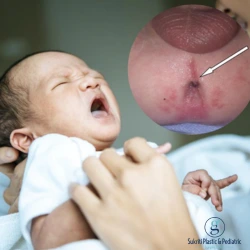 Anorectal Malformation in Newborns: A Parent's Complete Guide anorectal malformation, anorectal malformation in newborns, anorectal malformation treatment, anorectal malformation treatment in Indore, anorectal malformation surgery, ARM in newborns, ARM treatment in Indore, imperforate anus, imperforate anus treatment, imperforate anus surgery, absent anus in newborn, newborn unable to pass stool, anorectal malformation symptoms, anorectal malformation causes, congenital anorectal malformation, pediatric anorectal surgery, PSARP surgery, PSARP surgery in Indore, posterior sagittal anorectoplasty, colostomy in newborns, rectoperineal fistula, rectourethral fistula, rectovestibular fistula, cloacal malformation, pediatric surgeon in Indore, best pediatric surgeon in Indore, Dr Saurabh Garge, Dr Saurabh Garge Indore, newborn surgery in Indore, congenital anomaly treatment in Indore