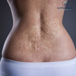 burn scar treatment in Indore, burn scar removal in Indore, burn scar surgery in Indore, burn scar revision in Indore, burn scar contracture treatment, burn scar contracture surgery, plastic surgeon for burn scars in Indore, reconstructive plastic surgeon in Indore, burn reconstruction surgery, hypertrophic scar treatment, raised burn scar treatment, old burn scar treatment, burn scar correction, burn scar plastic surgery, post burn scar treatment, post burn contracture treatment, scar revision surgery in Indore, burn scar treatment specialist, plastic surgeon in Indore, Dr Geetika Paliwal, burn scar reconstruction, skin grafting for burn scars, Z plasty for burn scars, burn scar tightness treatment, burn scar itching treatment, burn scar treatment options, facial burn scar treatment, hand burn scar treatment, neck burn contracture treatment, burn scar surgery recovery