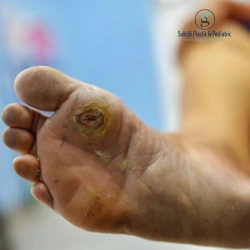 diabetic foot infection treatment Indore, diabetic foot surgery Indore, diabetic foot surgeon Indore, diabetic foot specialist Indore, diabetic wound treatment Indore, diabetic foot ulcer treatment Indore, diabetic foot infection surgeon Indore, diabetic foot wound doctor Indore, diabetic foot care Indore, diabetic ulcer surgeon Indore, gangrene treatment Indore, diabetic gangrene treatment Indore, foot infection surgery Indore, infected diabetic foot treatment, diabetic wound surgery, diabetic foot abscess treatment, diabetic foot debridement Indore, diabetic foot ulcer surgery, diabetic wound care Indore, non healing wound treatment Indore, diabetic foot infection symptoms, diabetic foot infection surgery, urgent diabetic foot surgery, severe diabetic foot infection, diabetic foot gangrene surgery, diabetic foot osteomyelitis treatment, diabetic foot doctor Madhya Pradesh, Dr Geetika Paliwal Indore, Dr Geetika Paliwal surgeon, diabetic foot treatment Madhya Pradesh