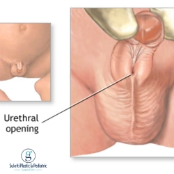 hypospadias surgery in Indore, hypospadias treatment in Indore, pediatric surgeon in Indore, hypospadias surgeon in Indore, hypospadias surgery for children, hypospadias in babies, hypospadias in children, hypospadias repair surgery, hypospadias treatment for child, best age for hypospadias surgery, hypospadias surgery age, hypospadias symptoms in babies, abnormal urine opening in child, urethral opening below penis, penile curvature in children, chordee in children, congenital penile abnormality, pediatric urology surgery Indore, child surgery in Indore, pediatric surgical care Indore, hypospadias operation, hypospadias correction surgery, recovery after hypospadias surgery, catheter after hypospadias surgery, circumcision before hypospadias surgery, hypospadias specialist Indore, hypospadias repair in babies, pediatric genital surgery, congenital condition in boys, Dr Saurabh Garge pediatric surgeon